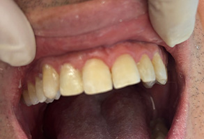 Dental Village Associates, PC | Implant Restorations, Veneers and Fluoride Treatment