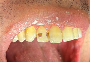 Dental Village Associates, PC | Night Guards, Dental Sealants and Dentures