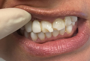 Dental Village Associates, PC | LANAP reg , Implant Dentistry and Dental Cleanings