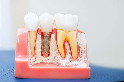 dental-implants